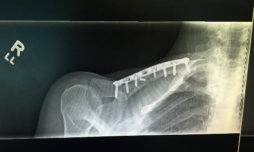 Kathryn Bertine XRay
